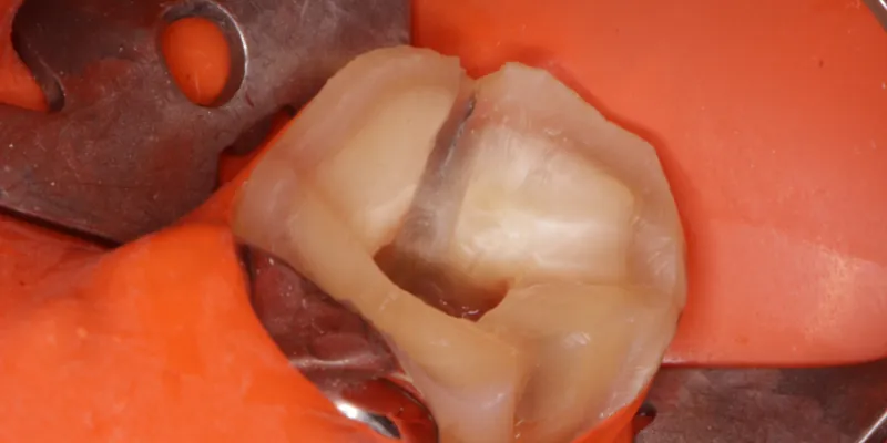 러버댐으로 격리한 어금니, 치아를 가로지르는 균열선