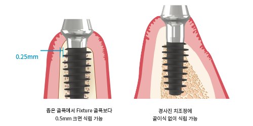 좁은 잇몸뼈와 경사진 잇몸뼈에 IBS 매직코어를 심은 단면 그림